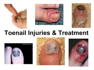 Toenail Injuries & Treatment
 