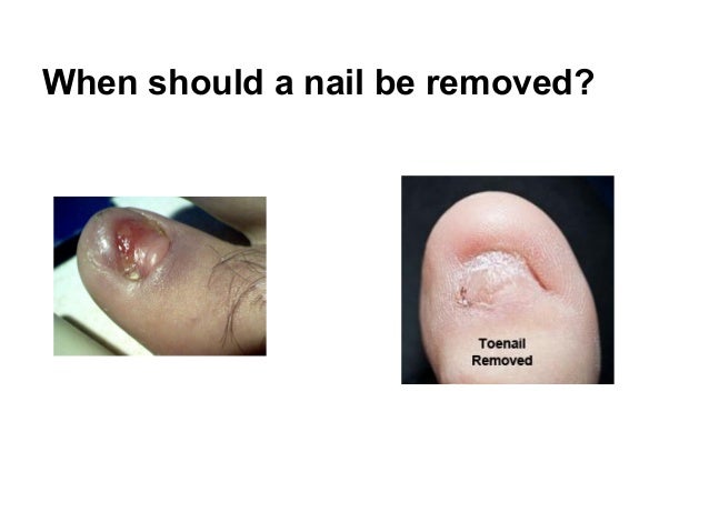 Nail injuries