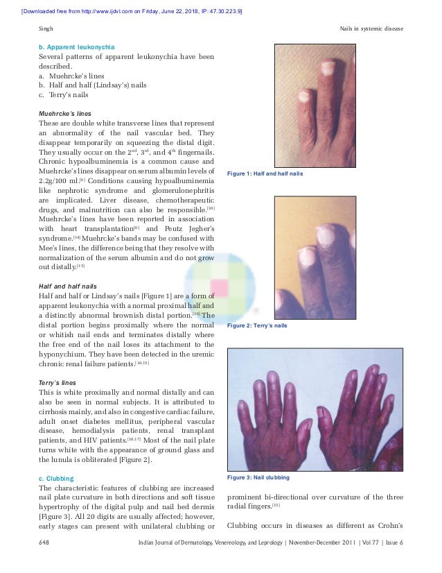 Nail In Systemic Diseases Nail In Systemic Diseases