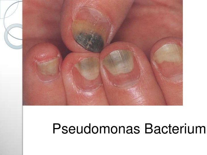 How To Treat Pseudomonas Bacterial Infection Toenail Nail Ftempo