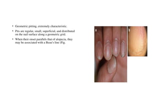 Geometric Pits nail psoriasis is one of the manifestations of psoriasis | PPTX