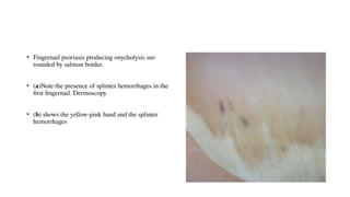 nail psoriasis is one of the manifestations of psoriasis | PPTX