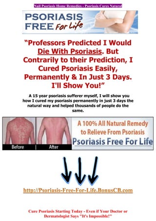Nail Psoriasis Home Remedies - Psoriasis Cures Natural




“Professors Predicted I Would
   Die With Psoriasis. But
Contrarily to their Prediction, I
    Cured Psoriasis Easily,
Permanently & In Just 3 Days.
        I'll Show You!”
   A 15 year psoriasis sufferer myself, I will show you
how I cured my psoriasis permanently in just 3 days the
  natural way and helped thousands of people do the
                         same.




  Cure Psoriasis Starting Today - Even if Your Doctor or
          Dermatologist Says "It's Impossible!"
 