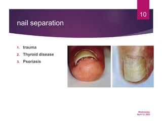 Wednesday,
April 12, 2023
10
nail separation
1. trauma
2. Thyroid disease
3. Psoriasis
 