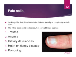 Wednesday,
April 12, 2023
12
Pale nails
 Leukonychia, describes fingernails that are partially or completely white in
color.
 The white color could be the result of several things such as
1. Trauma
2. Anemia
3. Dietary deficiencies
4. Heart or kidney disease
5. Poisoning.
 