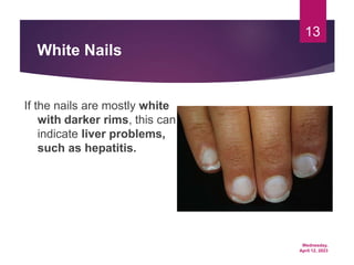 Wednesday,
April 12, 2023
13
White Nails
If the nails are mostly white
with darker rims, this can
indicate liver problems,
such as hepatitis.
 