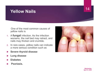 Wednesday,
April 12, 2023
14
Yellow Nails
One of the most common causes of
yellow nails is
1. A fungal infection. As the infection
worsens, the nail bed may retract, and
nails may thicken and crumble.
2. In rare cases, yellow nails can indicate
a more serious condition such as
 Severe thyroid disease
 Lung disease
 Diabetes
 Psoriasis.
 