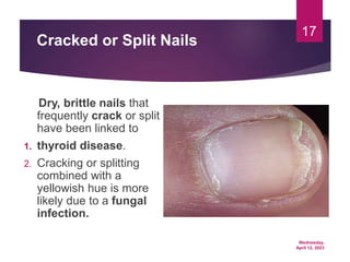 Wednesday,
April 12, 2023
17
Cracked or Split Nails
Dry, brittle nails that
frequently crack or split
have been linked to
1. thyroid disease.
2. Cracking or splitting
combined with a
yellowish hue is more
likely due to a fungal
infection.
 