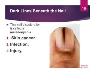 Wednesday,
April 12, 2023
19
Dark Lines Beneath the Nail
 This nail discoloration
is called a
melanonychia
1. Skin cancer.
2. Infection.
3. Injury.
 