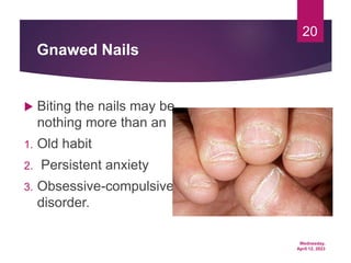 Wednesday,
April 12, 2023
20
Gnawed Nails
 Biting the nails may be
nothing more than an
1. Old habit
2. Persistent anxiety
3. Obsessive-compulsive
disorder.
 