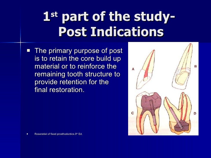 Endodontic Sealers