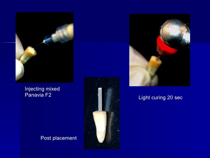 Endodontic Sealers