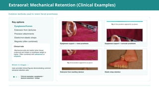 Retention Opties Examples Comprehensive Insights into Retention in Maxillofacial Prosthesis by ...