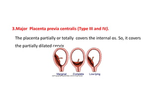 3.Major Placenta previa centralis (Type III and IV).
The placenta partially or totally covers the internal os. So, it covers
the partially dilated cervix
 