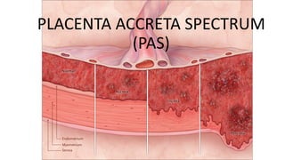 PLACENTA ACCRETA SPECTRUM
(PAS)
 