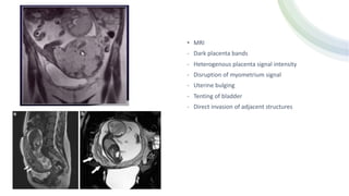 • MRI
- Dark placenta bands
- Heterogenous placenta signal intensity
- Disruption of myometrium signal
- Uterine bulging
- Tenting of bladder
- Direct invasion of adjacent structures
 