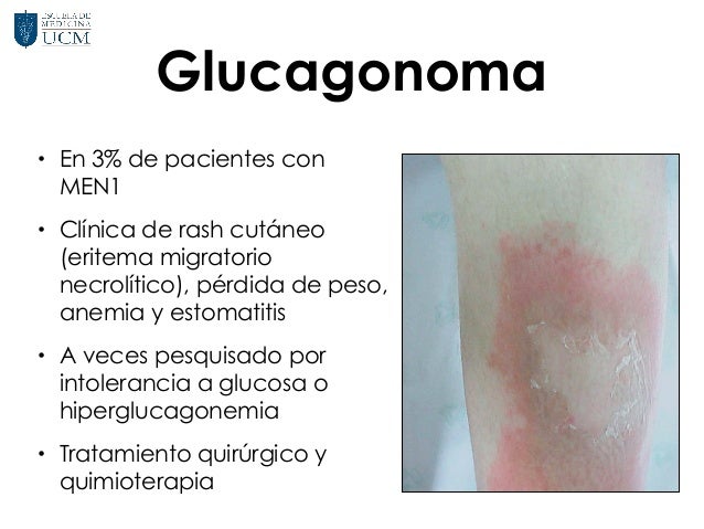 Fisiopatología de Neoplasias Endocrinas Múltiples y Fisiopatología de Neoplasias Endocrinas Múltiples y