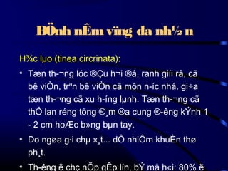 BÖnh nÊm vïng da nh½ n
H¾c lµo (tinea circrinata):
• Tæn th­¬ng lóc ®Çu h¬i ®á, ranh giíi râ, cã
bê viÒn, trªn bê viÒn cã môn n­íc nhá, gi÷a
tæn th­¬ng cã xu h­íng lµnh. Tæn th­¬ng cã
thÓ lan réng tõng ®¸m ®a cung ®­êng kÝnh 1
- 2 cm hoÆc b»ng bµn tay.
• Do ngøa g·i chµ x¸t... dÔ nhiÔm khuÈn thø
ph¸t.
• Th­êng ë chç nÕp gÊp lín, bÝ må h«i: 80% ë

 