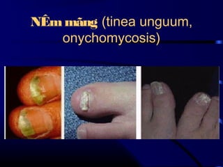 NÊm mãng (tinea unguum,
onychomycosis)

 