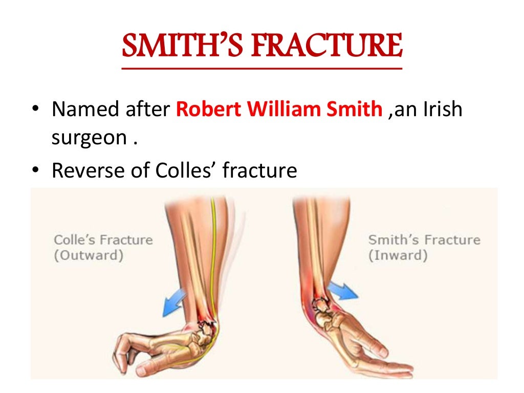 Named fractures of forearm ,wrist &and hand