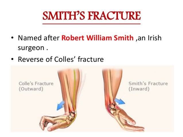 colles smith fracture colles smith fracture