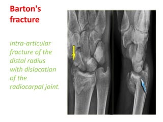 Barton's
fracture

intra-articular
fracture of the
distal radius
with dislocation
of the
radiocarpal joint.
 