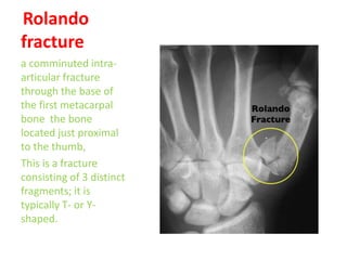 Name fractures | PPTX