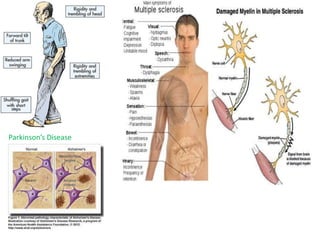 Parkinson’s Disease
 
