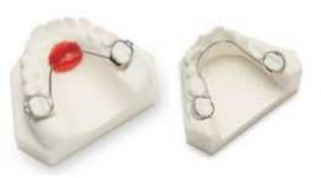 lower lingual holding arch
