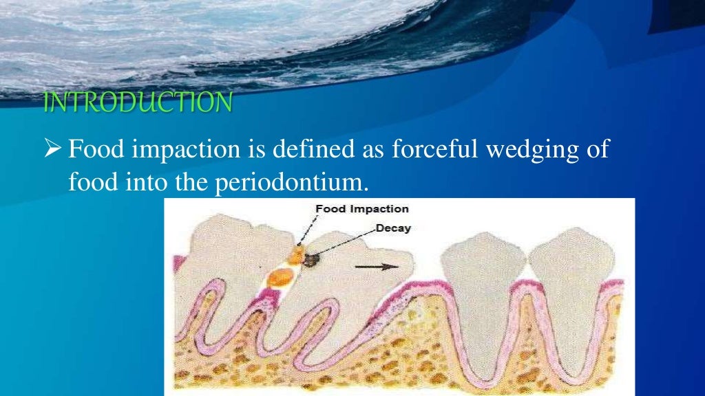 FOOD IMPACTION AND TREATMENT