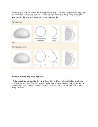 Nếu nâng ngực bằng mỡ tự thân, thì bầu ngực sẽ đẹp trong 3 – 5 năm; còn phẫu thuật nâng ngực
nội soi thì ngực sẽ được đẹp trọn đời. Vì Thẩm mỹ viện Bác sĩ Ngô Mộng Hùng sử dụng túi
ngực cao cấp, được chứng nhận an toàn và bảo hành trọn đời.
Nên chọn phương pháp nâng ngực nào?
+ Nâng ngực bằng mỡ tự thân: lấy mỡ từ bụng, đùi, eo, hông… rồi sau đó chiết tách ly tâm,
lọc ly tâm giữ lại những tế bào mỡ nguyên chất để bơm lên ngực. Phương pháp này có hạn chế
lớn là chỉ hiệu quả 3 - 5 năm. Và mỡ có thể bị vôi hóa, hình thành các khối như khối u, ảnh
hưởng sức khỏe.
 