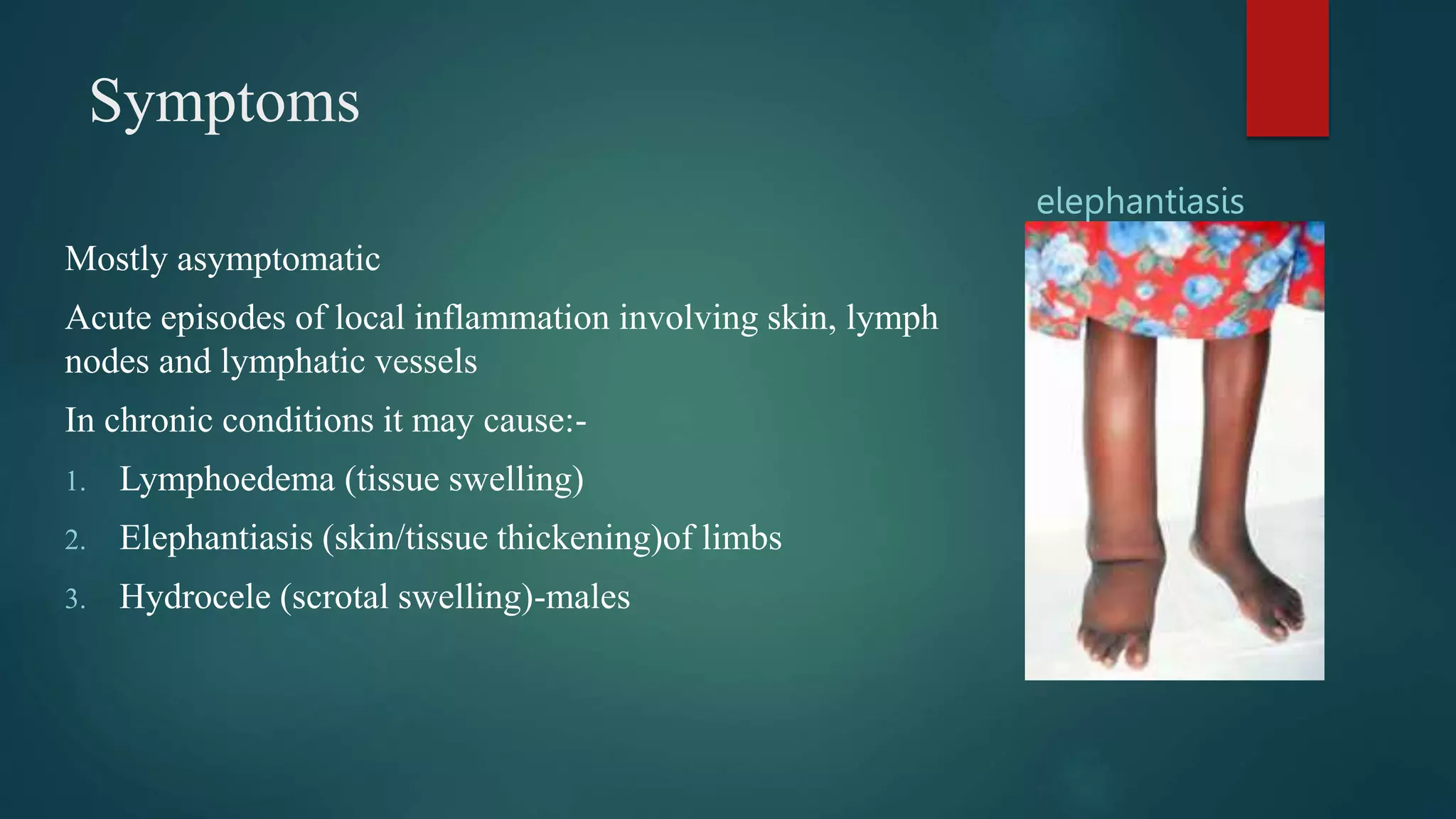 Symptoms
Mostly asymptomatic
Acute episodes of local inflammation involving skin, lymph
nodes and lymphatic vessels
In chronic conditions it may cause:-
1. Lymphoedema (tissue swelling)
2. Elephantiasis (skin/tissue thickening)of limbs
3. Hydrocele (scrotal swelling)-males
elephantiasis