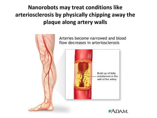 Nanorobots may treat conditions like
arteriosclerosis by physically chipping away the
            plaque along artery walls
 