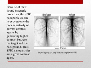 Because of their
strong magnetic
properties, the SPIO
nanoparticles can
help overcome the
poor sensitivity of
current contrast
agents by
generating higher
contrast between
the target and the
background. Thus
SPIO nanoparticles
are a great contrast
agent.
http://legacy.jyi.org/features/ft.php?id=750
 