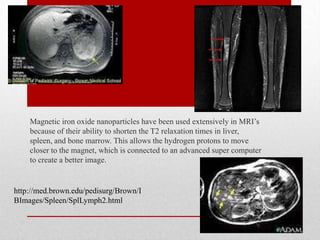 Magnetic iron oxide nanoparticles have been used extensively in MRI’s
because of their ability to shorten the T2 relaxation times in liver,
spleen, and bone marrow. This allows the hydrogen protons to move
closer to the magnet, which is connected to an advanced super computer
to create a better image.
http://med.brown.edu/pedisurg/Brown/I
BImages/Spleen/SplLymph2.html
 