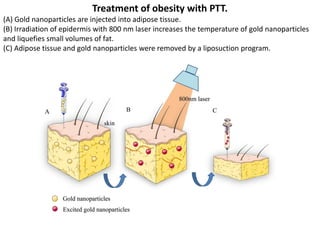 Treatment of obesity with PTT.
(A) Gold nanoparticles are injected into adipose tissue.
(B) Irradiation of epidermis with 800 nm laser increases the temperature of gold nanoparticles
and liquefies small volumes of fat.
(C) Adipose tissue and gold nanoparticles were removed by a liposuction program.
 