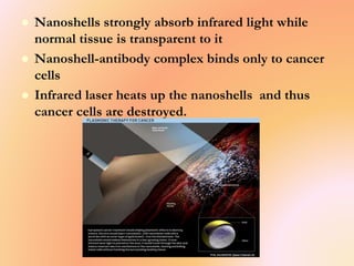  Nanoshells strongly absorb infrared light while
normal tissue is transparent to it
 Nanoshell-antibody complex binds only to cancer
cells
 Infrared laser heats up the nanoshells and thus
cancer cells are destroyed.
 