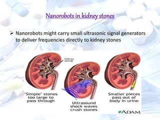  Nanorobots might carry small ultrasonic signal generators
to deliver frequencies directly to kidney stones
Nanorobots in kidney stones
 