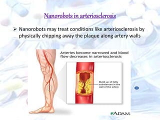 Nanorobots may treat conditions like arteriosclerosis by
physically chipping away the plaque along artery walls
Nanorobotsin arteriosclerosis
 