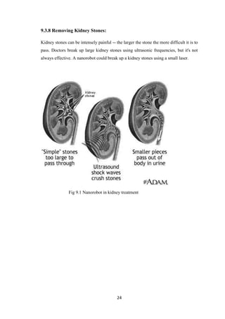 24
9.3.8 Removing Kidney Stones:
Kidney stones can be intensely painful -- the larger the stone the more difficult it is to
pass. Doctors break up large kidney stones using ultrasonic frequencies, but it's not
always effective. A nanorobot could break up a kidney stones using a small laser.
Fig 9.1 Nanorobot in kidney treatment
 