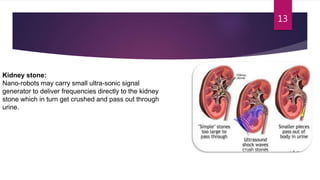 Nanorobot in human body