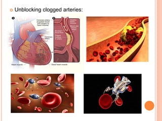  Unblocking clogged arteries:
 