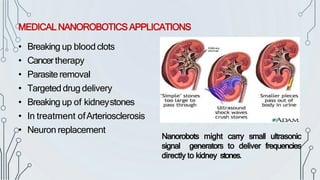 MEDICAL NANOROBOTICSAPPLICATIONS
• Breaking up blood clots
• Cancertherapy
• Parasiteremoval
• Targeted drug delivery
• Breaking up of kidneystones
• In treatment ofArteriosclerosis
• Neuron replacement
Nanorobots might carry small ultrasonic
signal generators to deliver frequencies
directly to kidney stones.
 