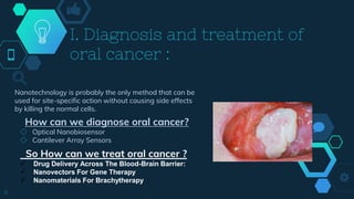 I. Diagnosis and treatment of
oral cancer :
Nanotechnology is probably the only method that can be
used for site-specific action without causing side effects
by killing the normal cells.
How can we diagnose oral cancer?
◇ Optical Nanobiosensor
◇ Cantilever Array Sensors
8
So How can we treat oral cancer ?
 Drug Delivery Across The Blood-Brain Barrier:
 Nanovectors For Gene Therapy
 Nanomaterials For Brachytherapy
 