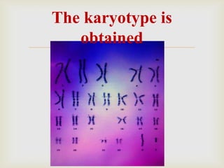 
The karyotype is
obtained
 