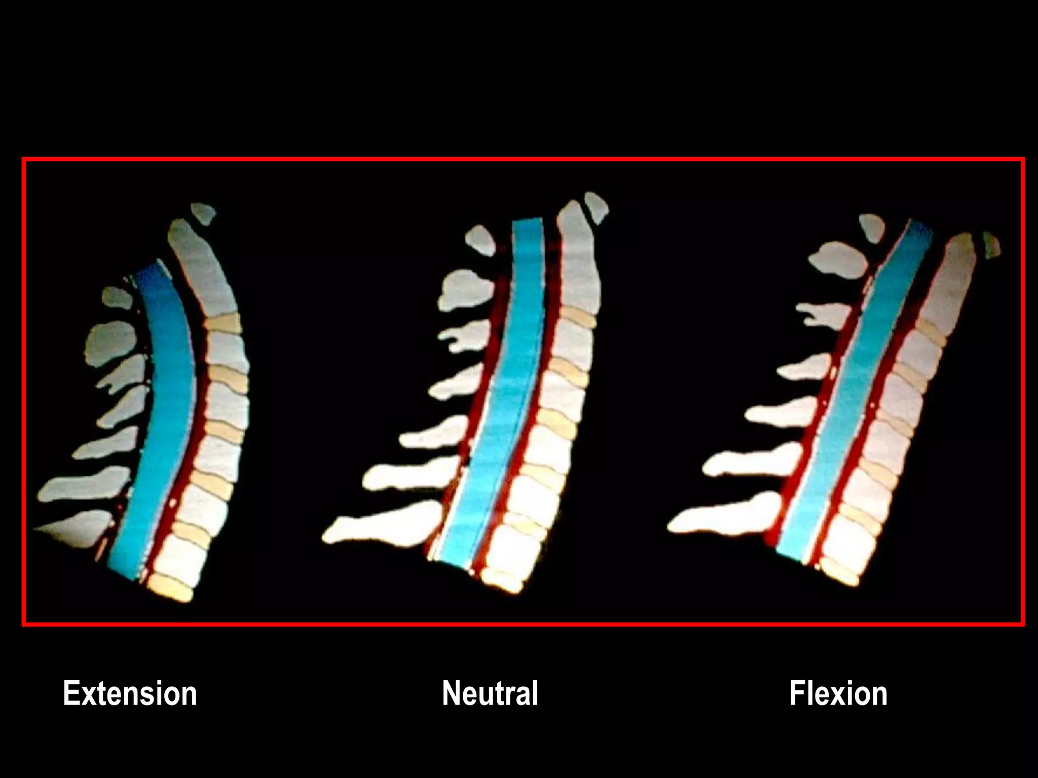 Extension Neutral Flexion
 