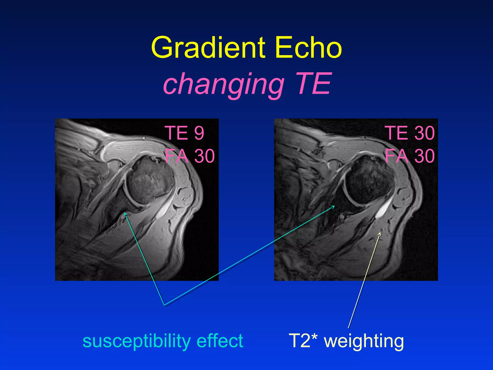 Gradient Echo
changing TE
TE 9
FA 30
TE 30
FA 30
susceptibility effect T2* weighting
 