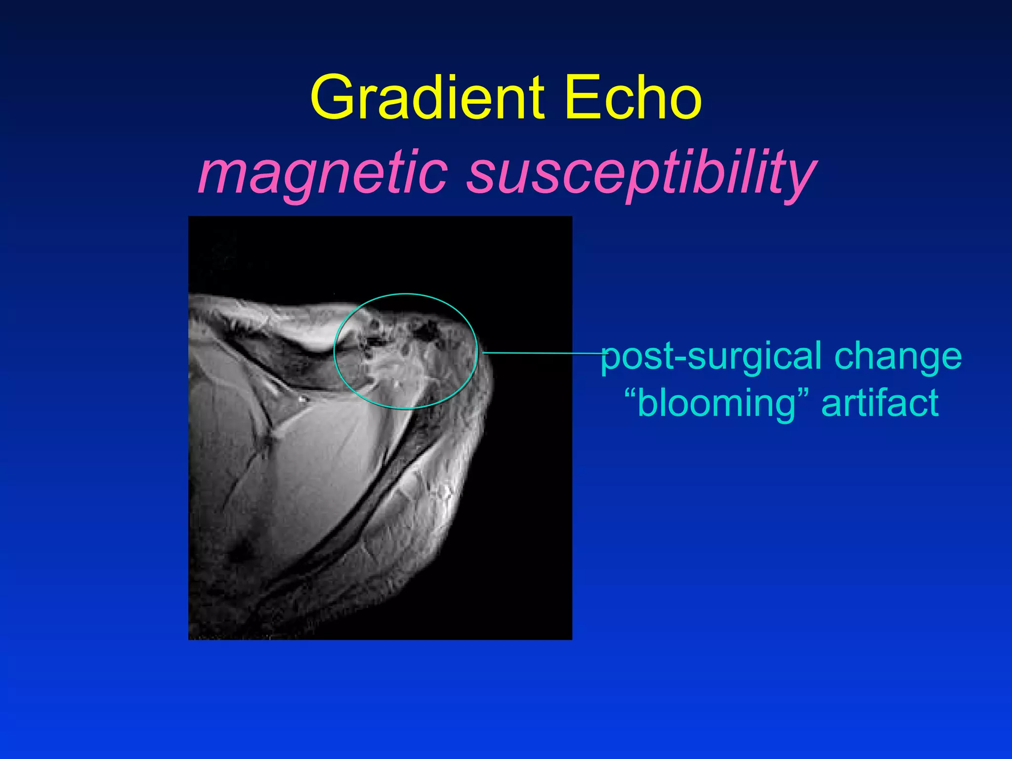 Gradient Echo
magnetic susceptibility
post-surgical change
“blooming” artifact
 