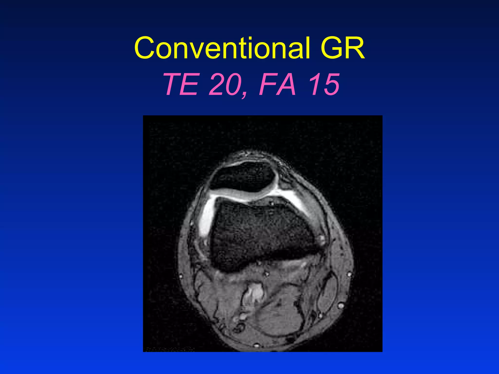 Conventional GR
TE 20, FA 15
 