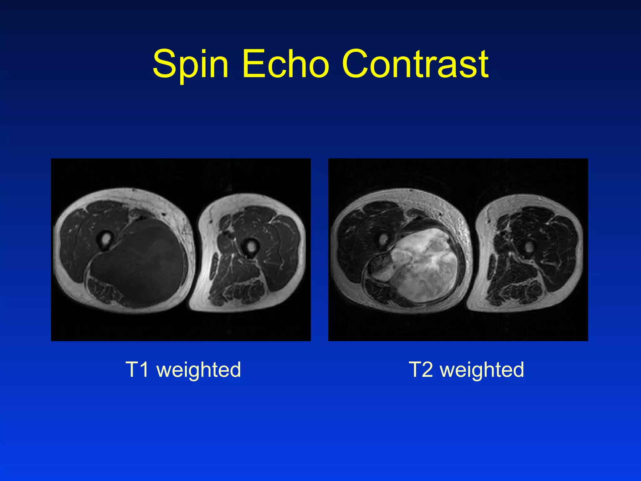 T1 weighted T2 weighted
Spin Echo Contrast
 